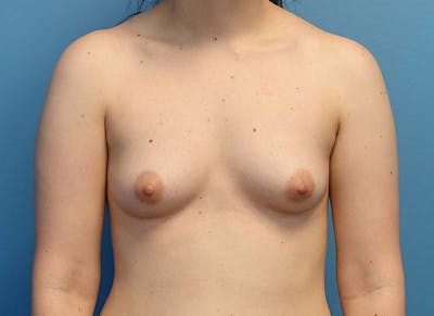 Augmentation Before & After Gallery - Patient 112338615 - Image 5