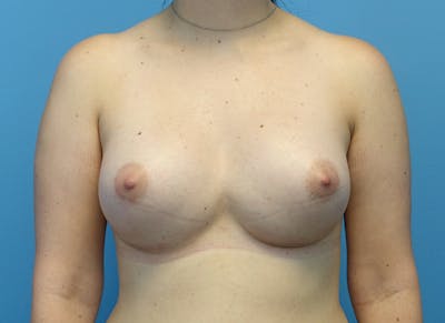 Augmentation Before & After Gallery - Patient 112338615 - Image 6