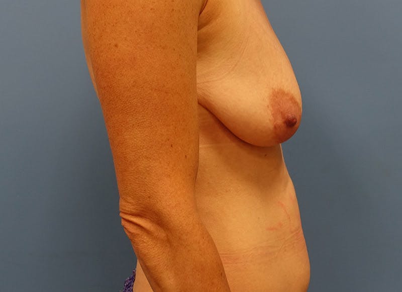 Breast Lift Before & After Gallery - Patient 112338613 - Image 9