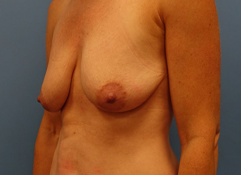 Breast Lift Before & After Gallery - Patient 112338613 - Image 3