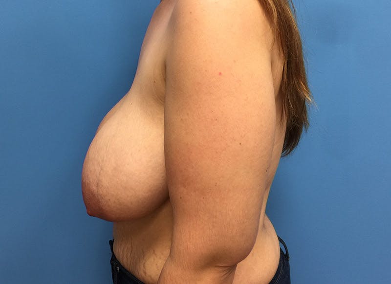 Breast Lift Before & After Gallery - Patient 112338617 - Image 1