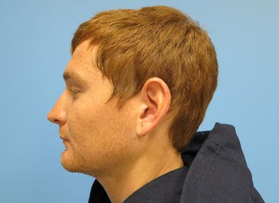 Rhinoplasty Before & After Gallery - Patient 112338621 - Image 1