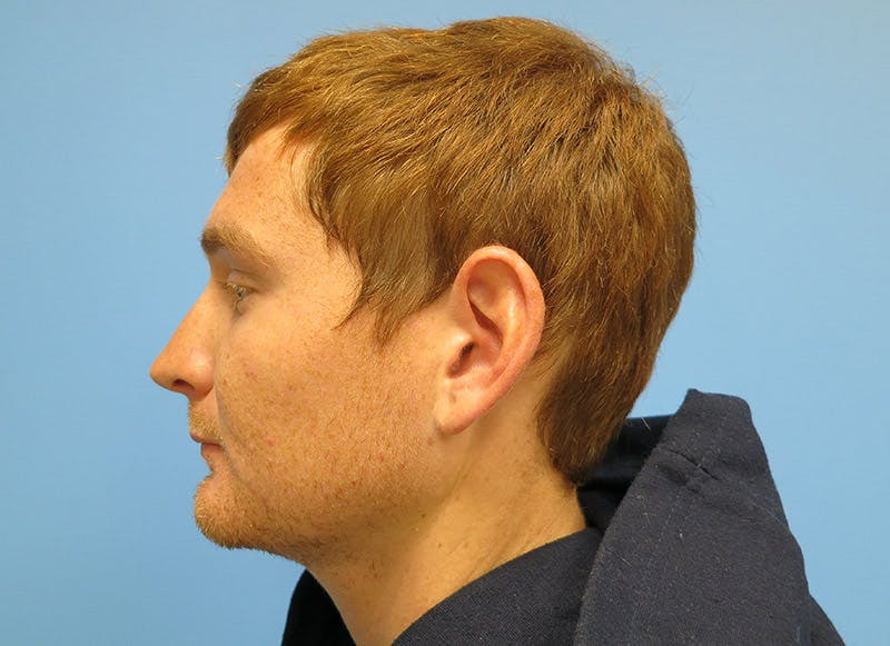 Rhinoplasty Before & After Gallery - Patient 112338621 - Image 1