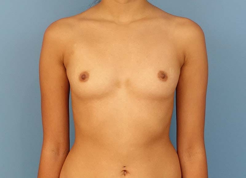 Augmentation Before & After Gallery - Patient 112338625 - Image 5