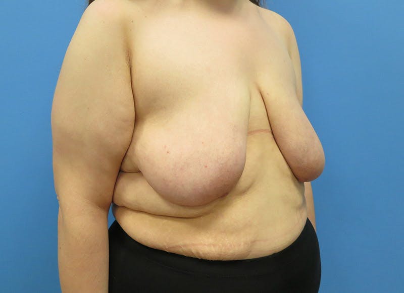 Breast Lift Before & After Gallery - Patient 112338623 - Image 7