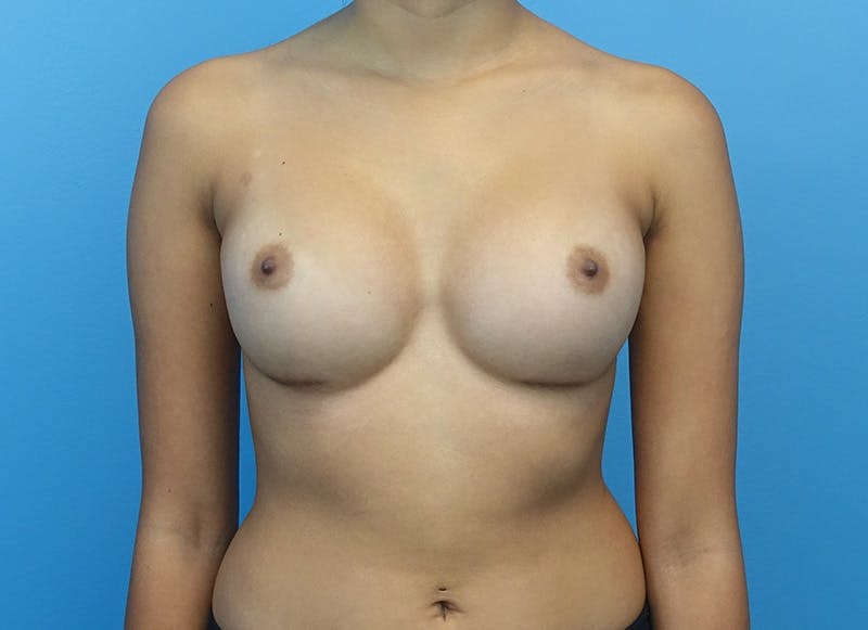 Augmentation Before & After Gallery - Patient 112338625 - Image 6