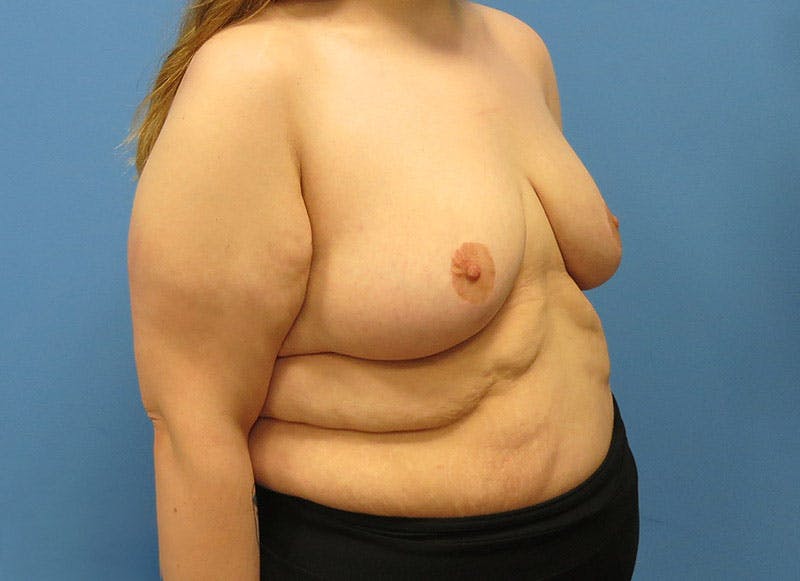 Breast Lift Before & After Gallery - Patient 112338623 - Image 8