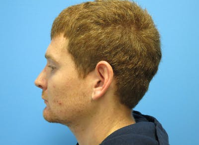 Rhinoplasty Before & After Gallery - Patient 112338621 - Image 2