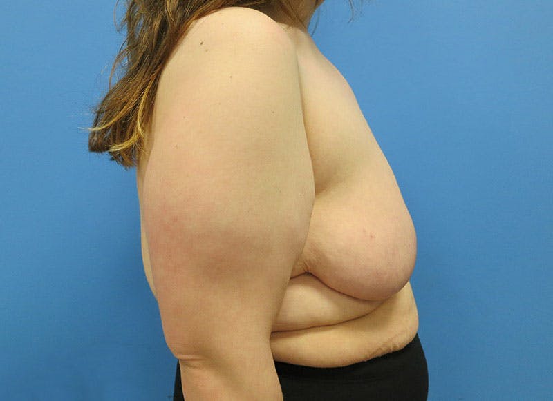 Breast Lift Before & After Gallery - Patient 112338623 - Image 9