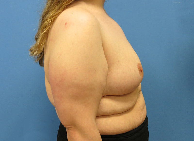 Breast Lift Before & After Gallery - Patient 112338623 - Image 10