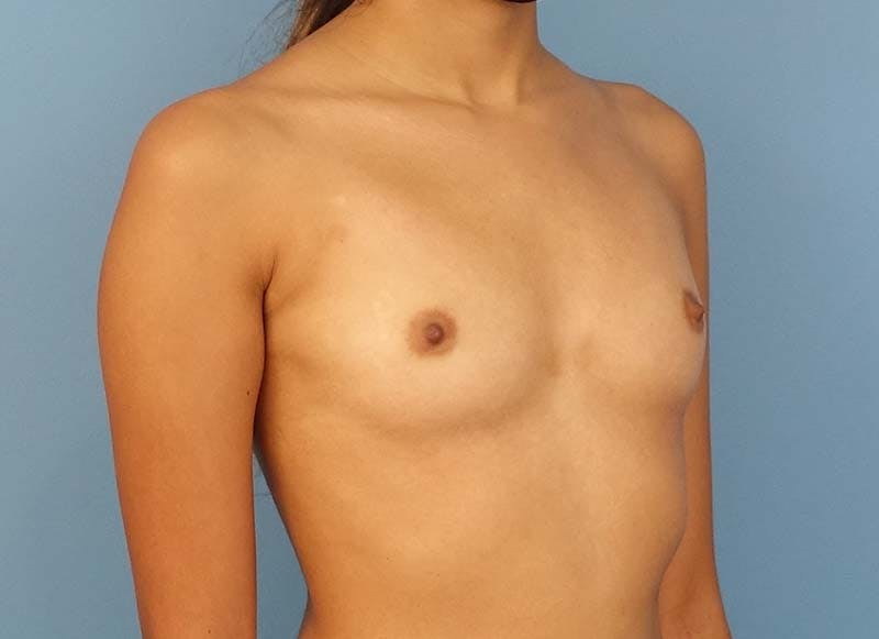 Augmentation Before & After Gallery - Patient 112338625 - Image 7