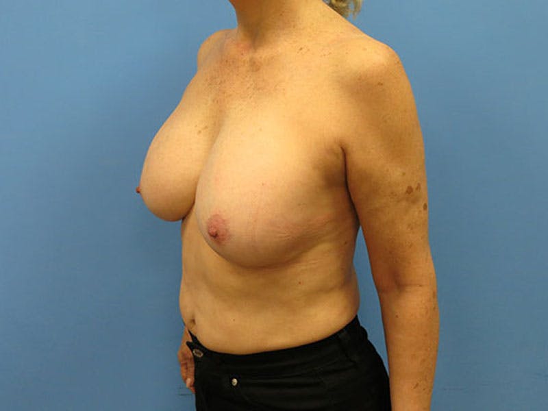 Implant Removal Before & After Gallery - Patient 112338624 - Image 3