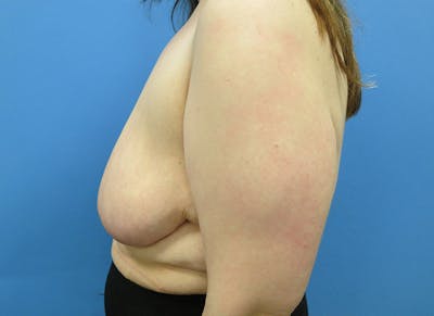 Breast Lift Before & After Gallery - Patient 112338623 - Image 1