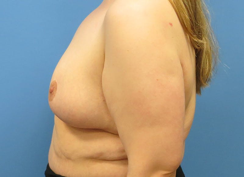 Breast Lift Before & After Gallery - Patient 112338623 - Image 2