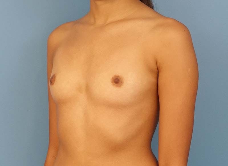 Augmentation Before & After Gallery - Patient 112338625 - Image 3