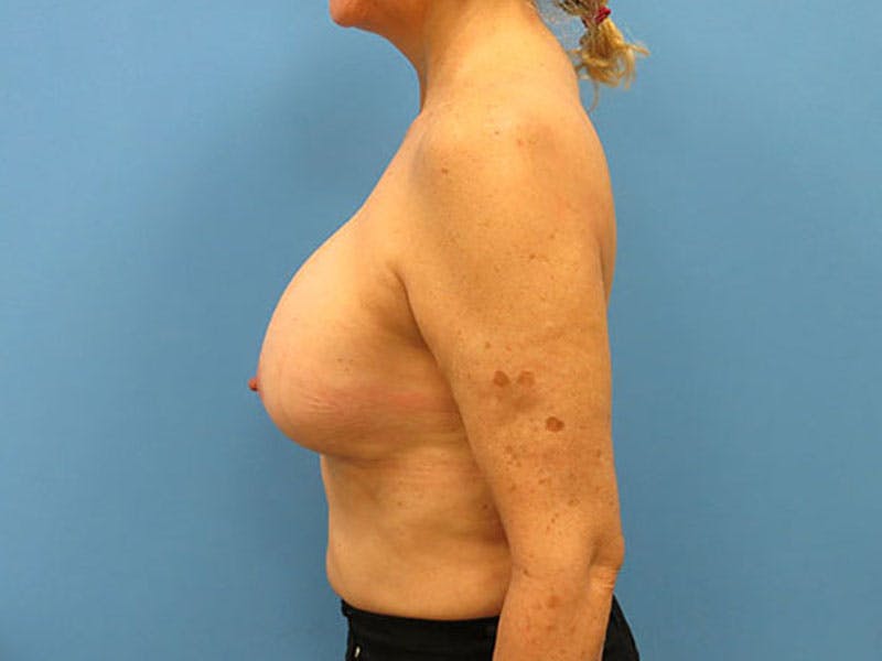 Implant Removal Before & After Gallery - Patient 112338624 - Image 1