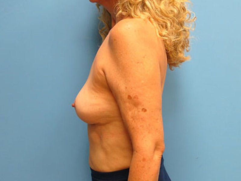 Implant Removal Before & After Gallery - Patient 112338624 - Image 2