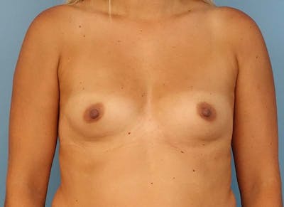 Augmentation Before & After Gallery - Patient 112338632 - Image 5
