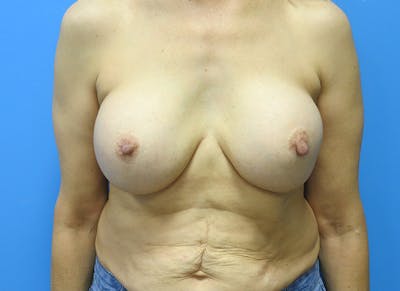 Implant Removal Before & After Gallery - Patient 112338634 - Image 5