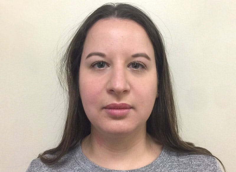 Rhinoplasty Before & After Gallery - Patient 112338626 - Image 5