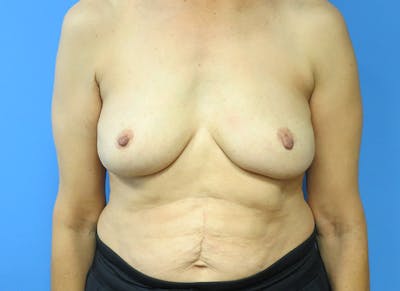 Implant Removal Before & After Gallery - Patient 112338634 - Image 6