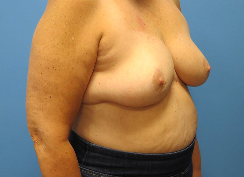 Breast Lift Before & After Gallery - Patient 112338631 - Image 8