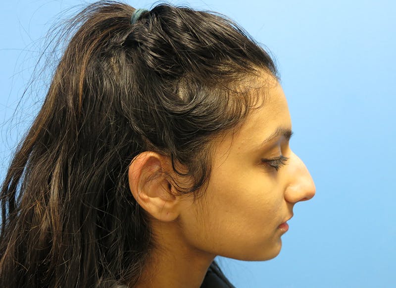 Rhinoplasty Before & After Gallery - Patient 112338637 - Image 9