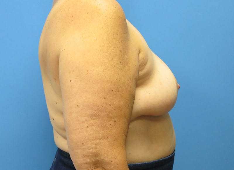 Breast Lift Before & After Gallery - Patient 112338631 - Image 10
