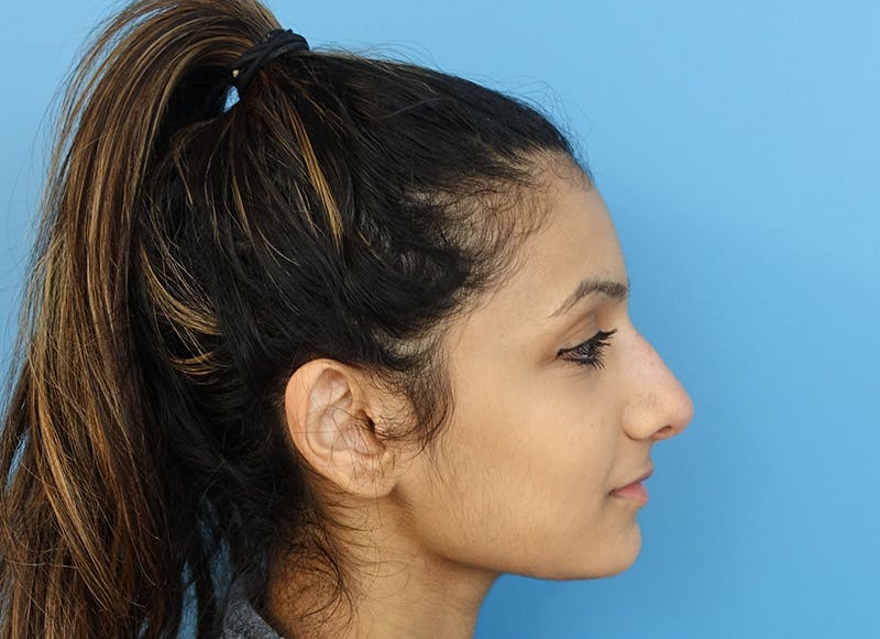 Rhinoplasty Before & After Gallery - Patient 112338637 - Image 10