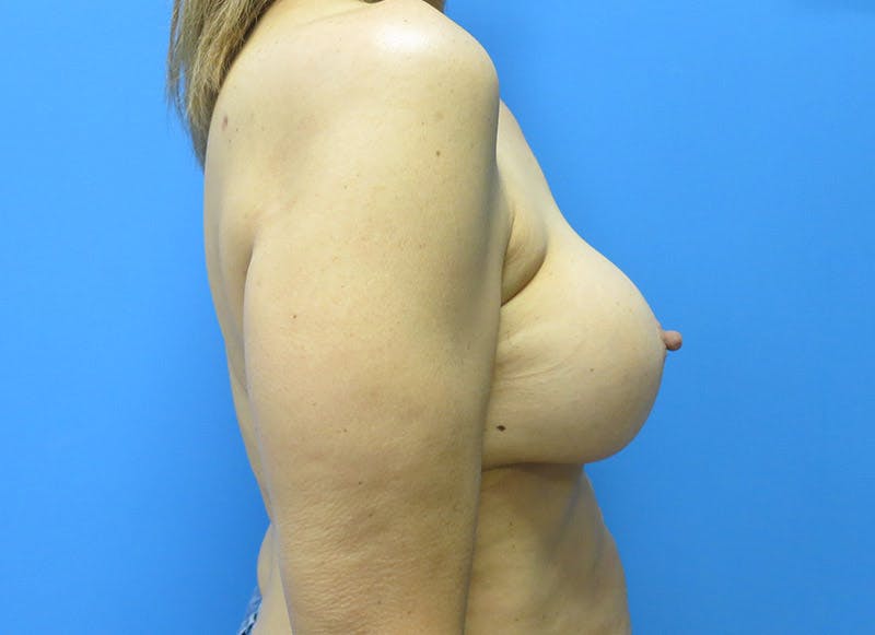 Implant Removal Before & After Gallery - Patient 112338634 - Image 9
