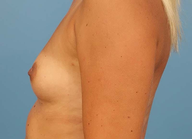 Augmentation Before & After Gallery - Patient 112338632 - Image 1