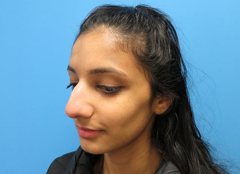 Rhinoplasty Before & After Gallery - Patient 112338637 - Image 3