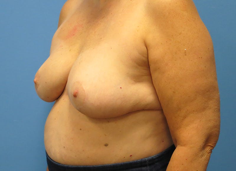 Breast Lift Before & After Gallery - Patient 112338631 - Image 4