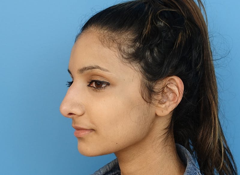 Rhinoplasty Before & After Gallery - Patient 112338637 - Image 4