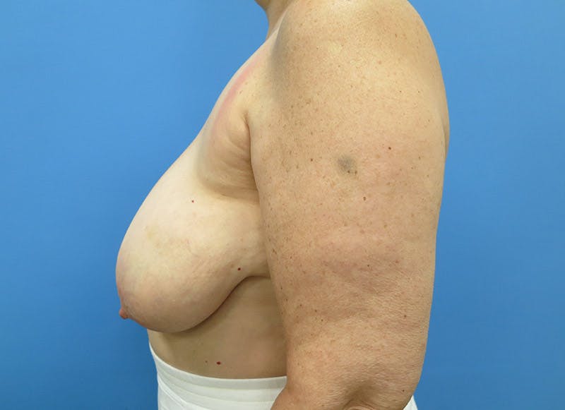 Breast Lift Before & After Gallery - Patient 112338631 - Image 1