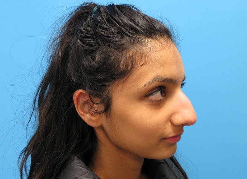 Rhinoplasty Before & After Gallery - Patient 112338637 - Image 7