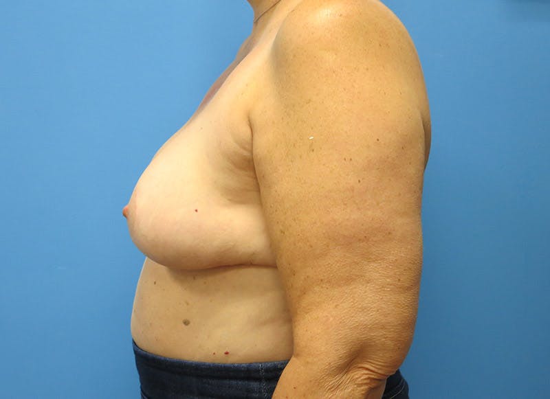 Breast Lift Before & After Gallery - Patient 112338631 - Image 2