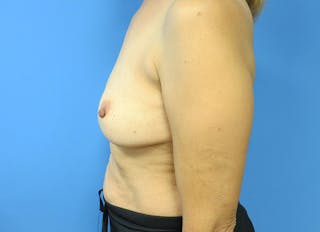 Implant Removal Before & After Gallery - Patient 112338634 - Image 2