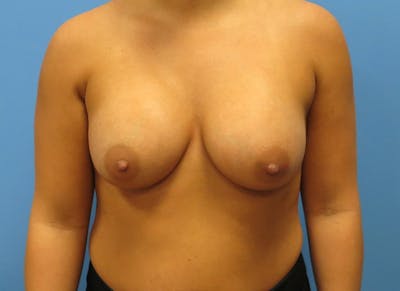 Augmentation Before & After Gallery - Patient 112338642 - Image 6