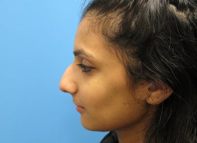 Rhinoplasty Before & After Gallery - Patient 112338637 - Image 1