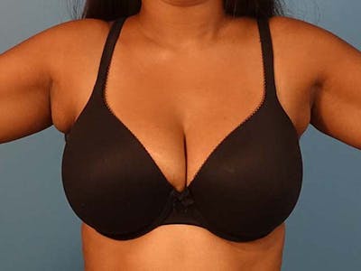 Axillary Breast Removal Before & After Gallery - Patient 112338636 - Image 1