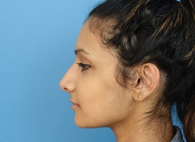 Rhinoplasty Before & After Gallery - Patient 112338637 - Image 2