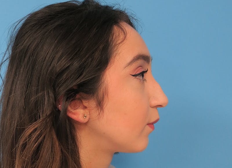 Rhinoplasty Before & After Gallery - Patient 112338654 - Image 9