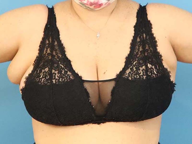 Axillary Breast Removal Before & After Gallery - Patient 112338639 - Image 1