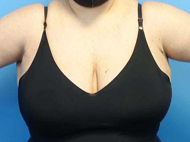 Axillary Breast Removal Before & After Gallery - Patient 112338639 - Image 2