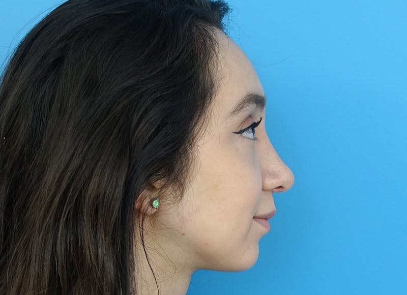Rhinoplasty Before & After Gallery - Patient 112338654 - Image 10