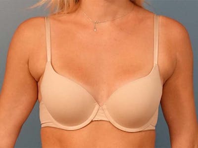 Axillary Breast Removal Before & After Gallery - Patient 112338641 - Image 1