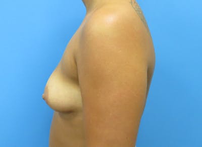 Augmentation Before & After Gallery - Patient 112338642 - Image 1