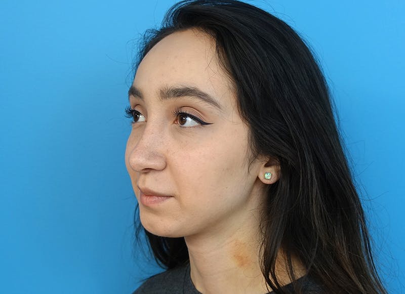 Rhinoplasty Before & After Gallery - Patient 112338654 - Image 4