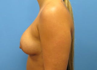 Augmentation Before & After Gallery - Patient 112338642 - Image 2
